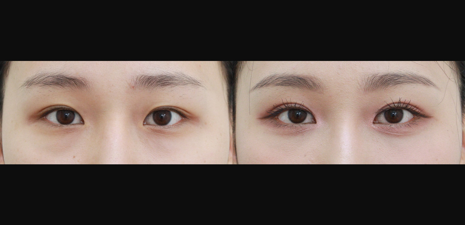 자연유착+트임+눈밑지방재배치