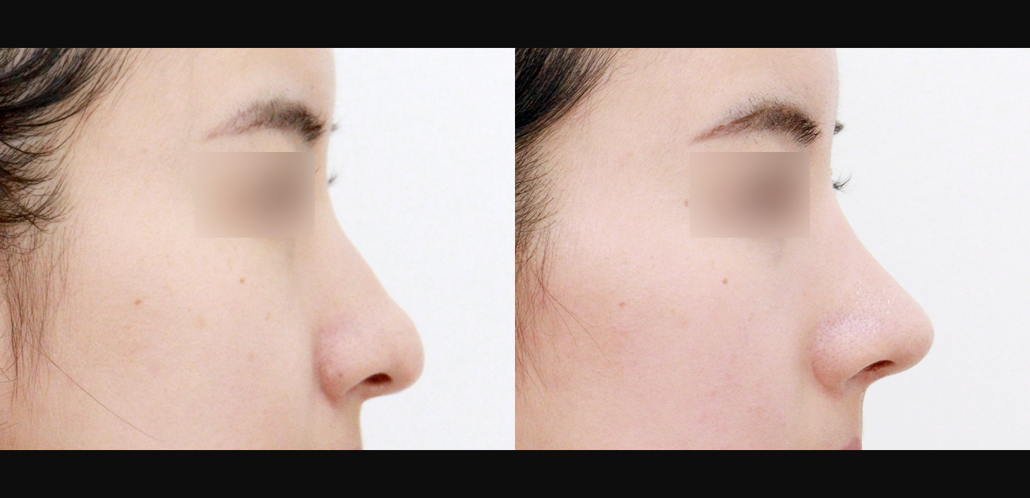 콧대+코끝+콧볼축소+기능코