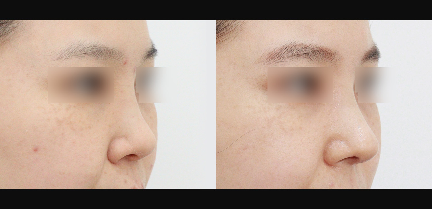 코재수술(콧대+코끝+휜코+인중코)