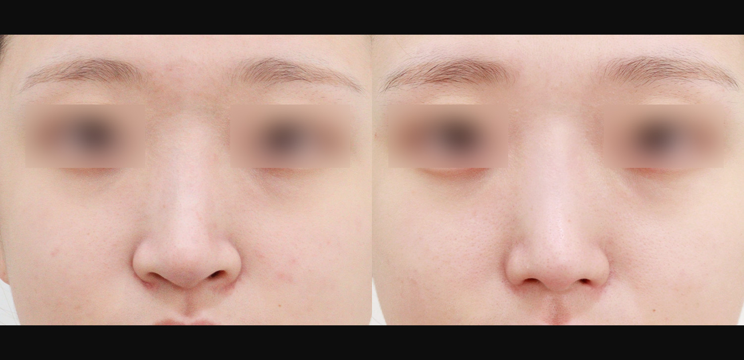 콧대+코끝+인중코+콧볼축소+기능코