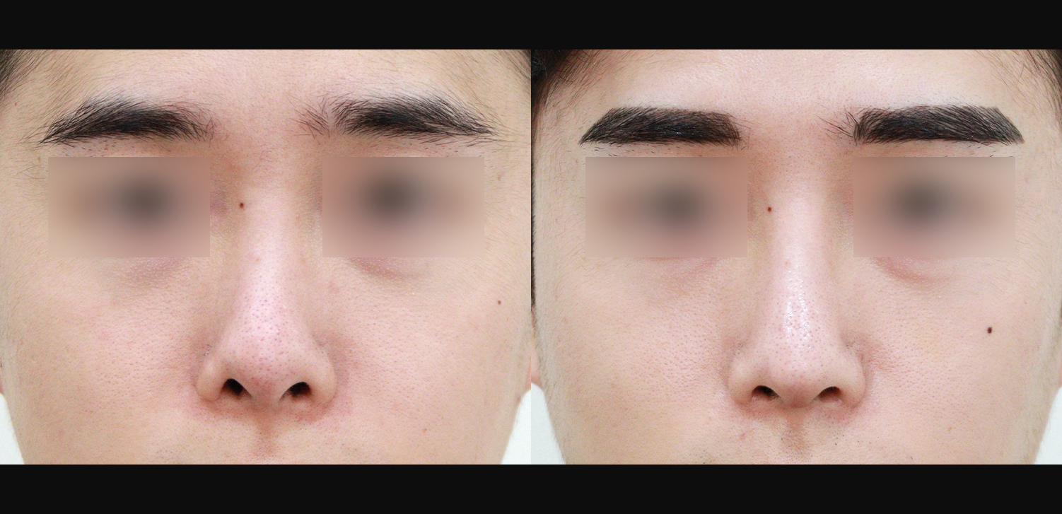 3D 코성형(콧대+코끝+인중코+기능코)