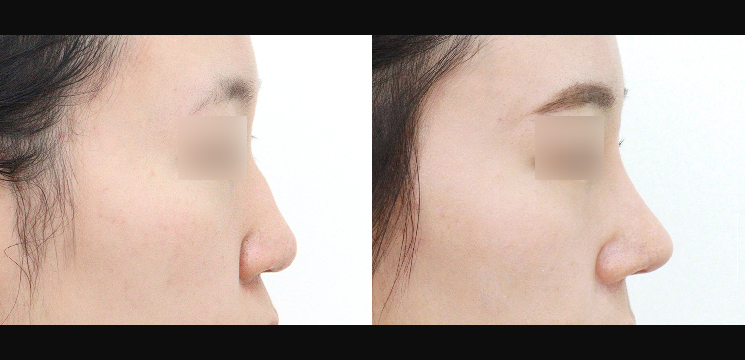 콧대+코끝+콧볼축소+인중코+기능코