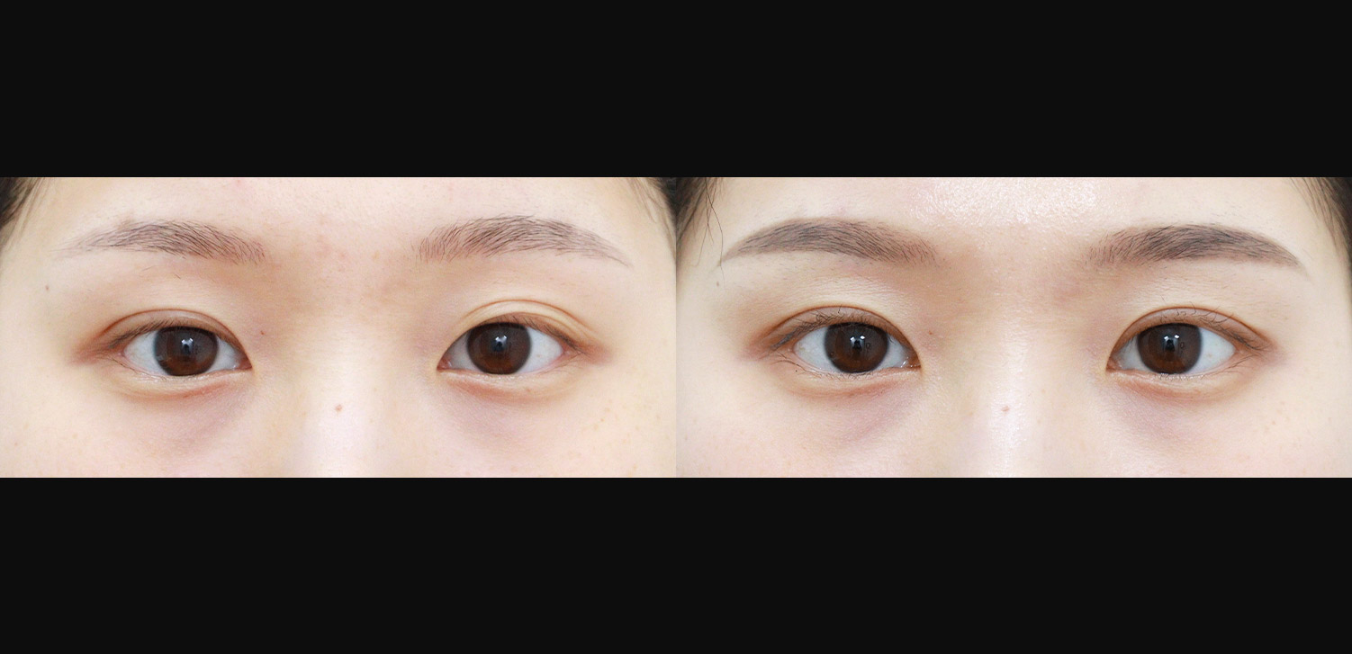 절개 쌍꺼풀+눈매교정