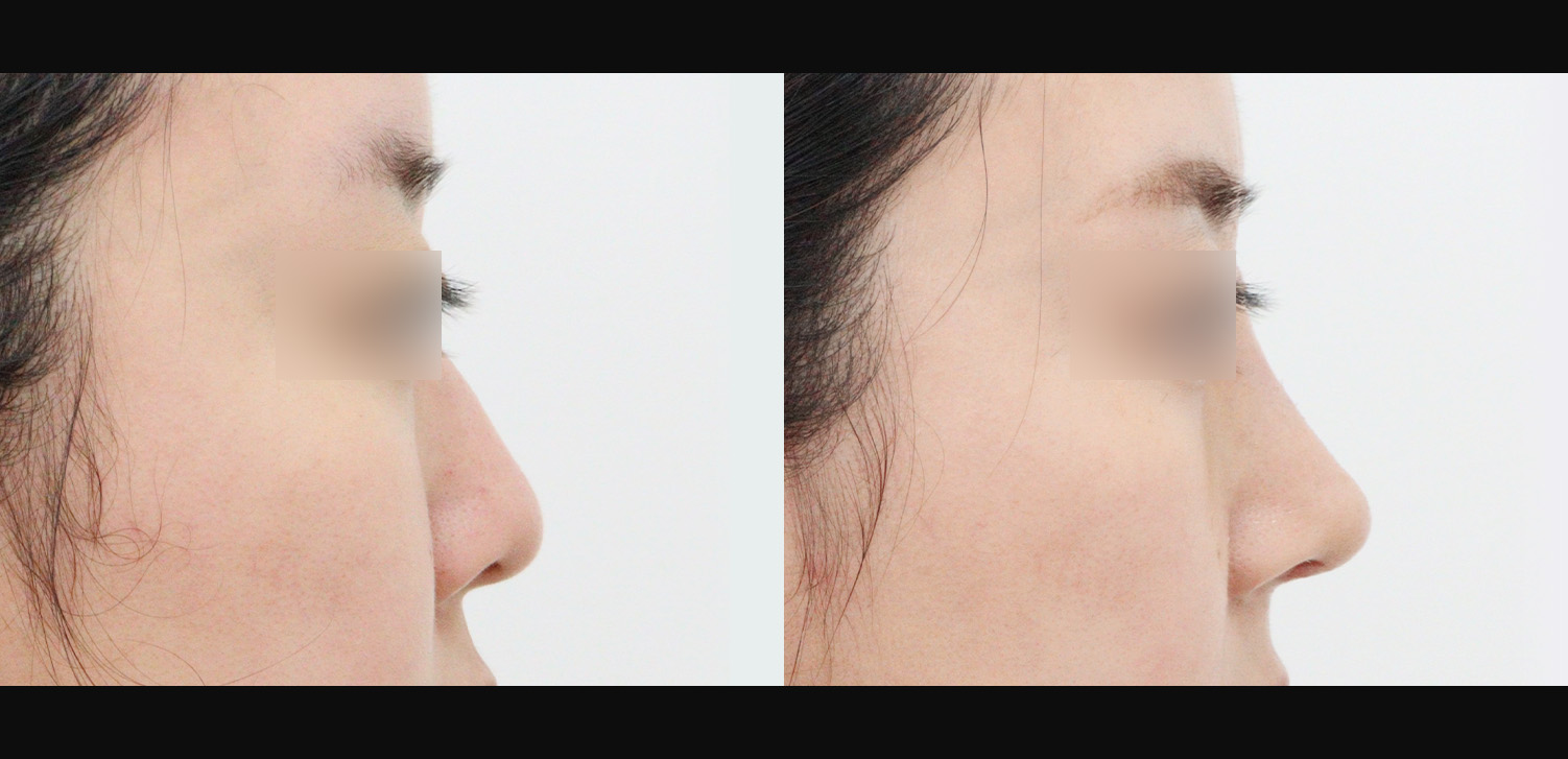 콧대+코끝+휜코+인중코