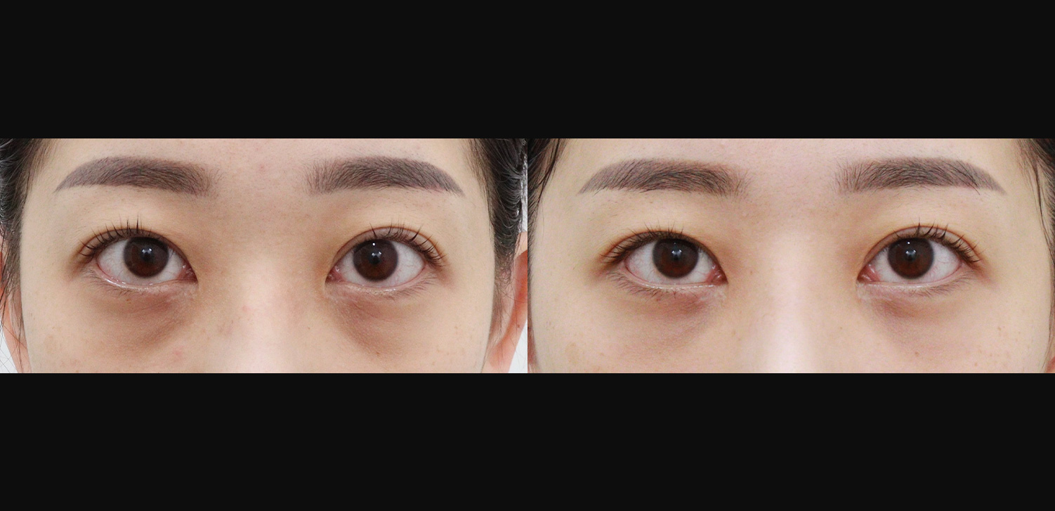 눈밑지방재배치+지방이식(앞광대)