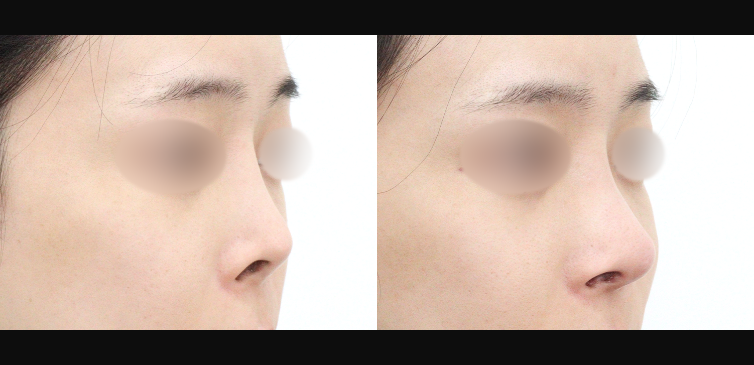 3D 코성형 재수술(콧대+코끝+기능코)