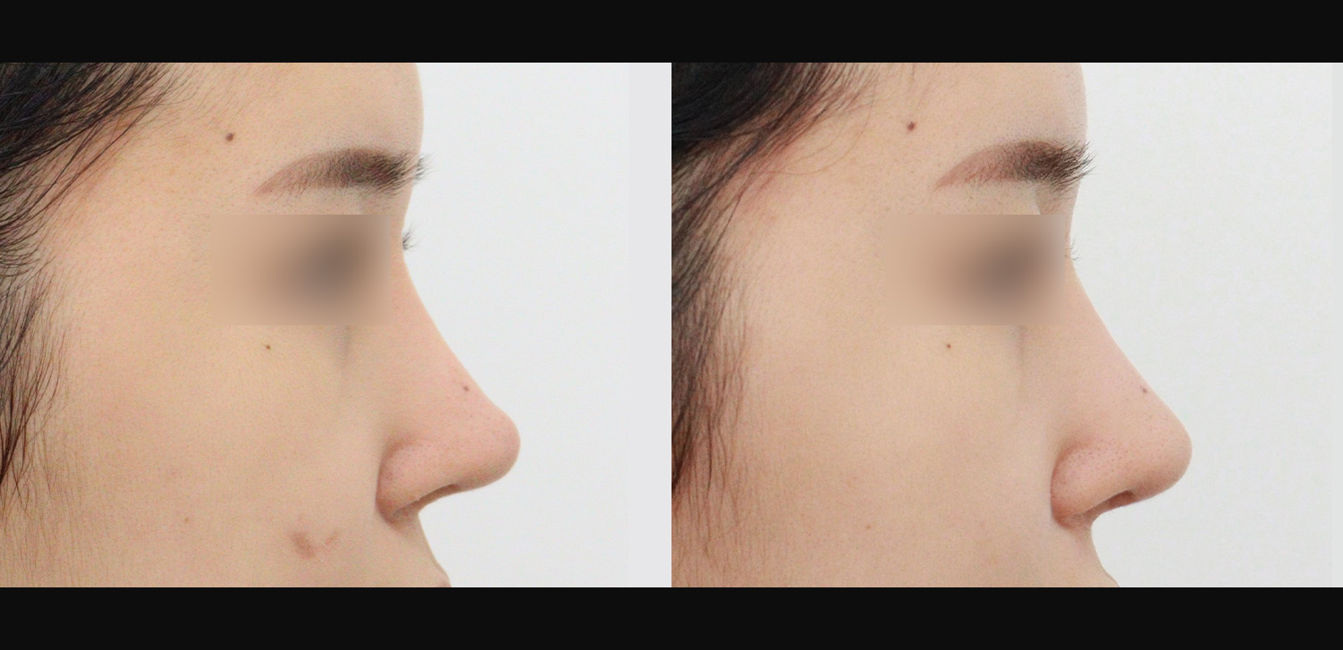 3D 코성형 재수술(콧대+코끝+인중코+기능코)