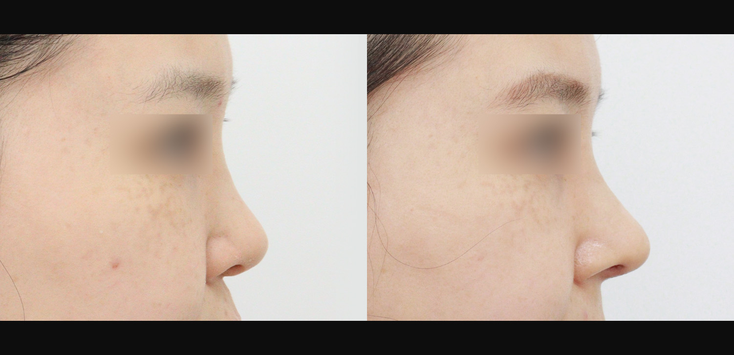 코재수술(콧대+코끝+휜코+인중코)