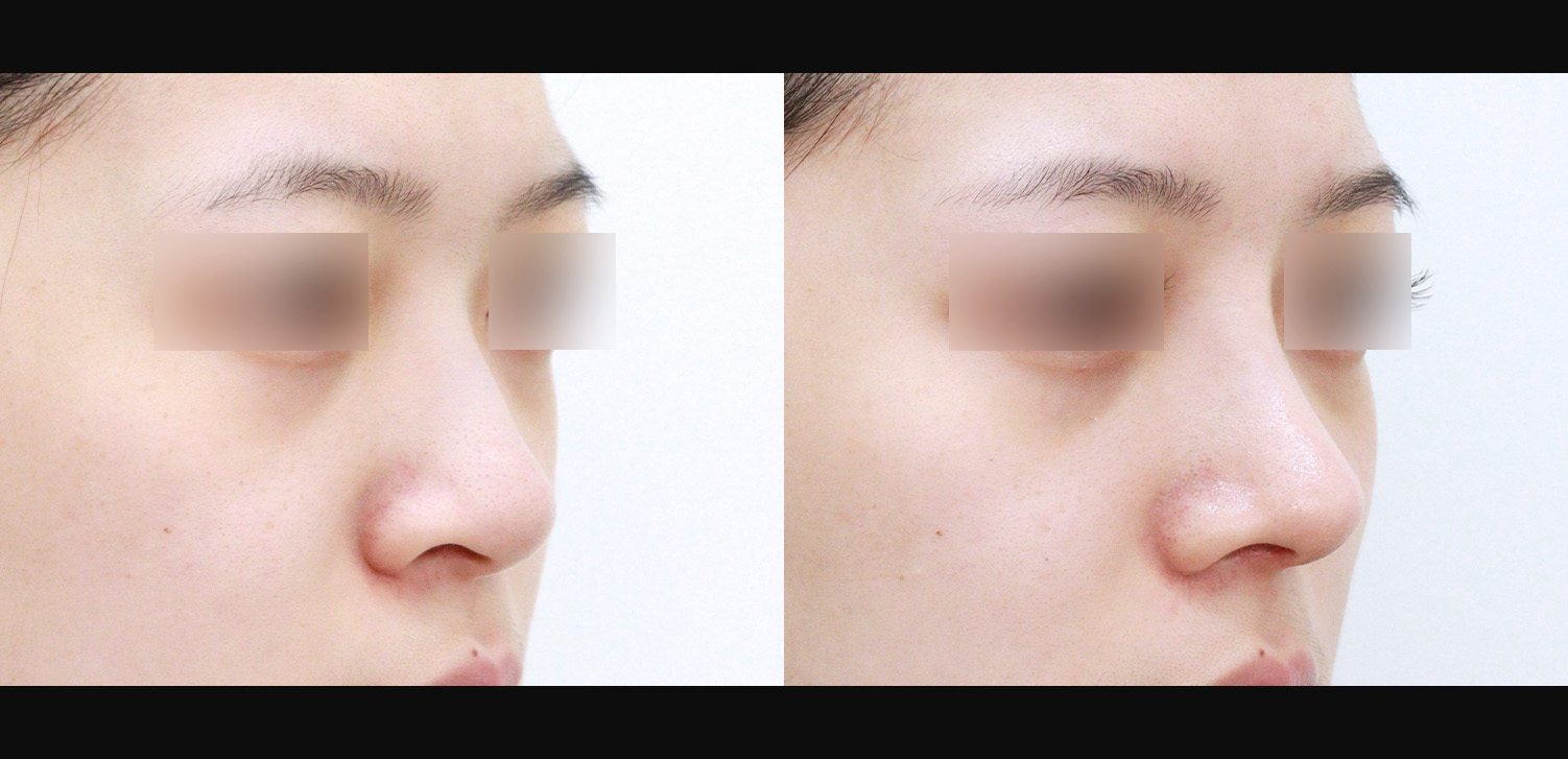 3D 코성형(자가늑+복코+콧볼축소+비주처짐+인중코, 기능코)