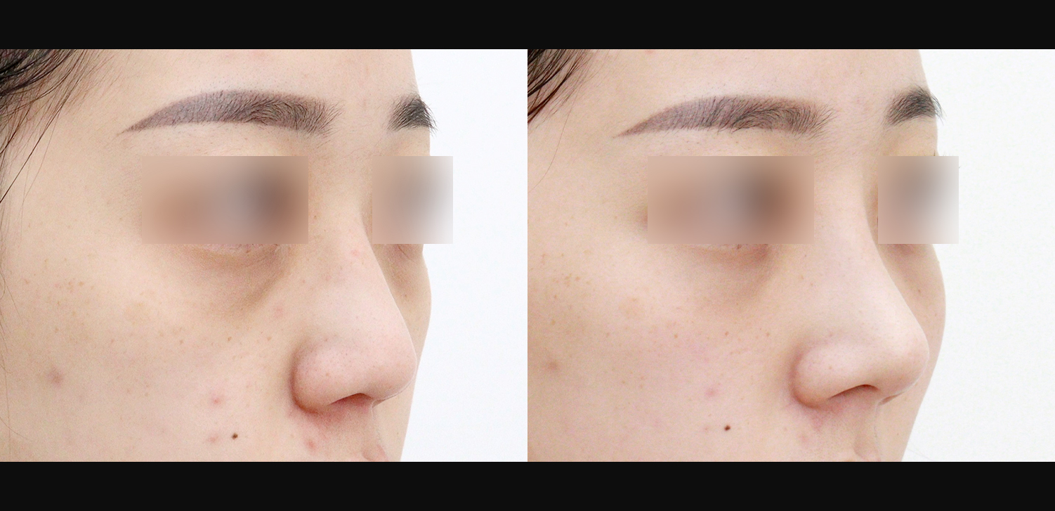 3D 코성형(콧대+코끝+복코+인중코)