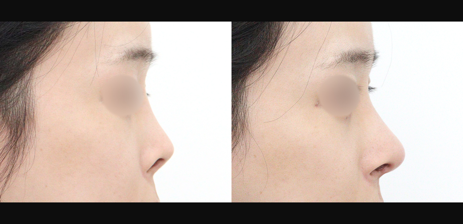 3D 코성형 재수술(콧대+코끝+기능코)