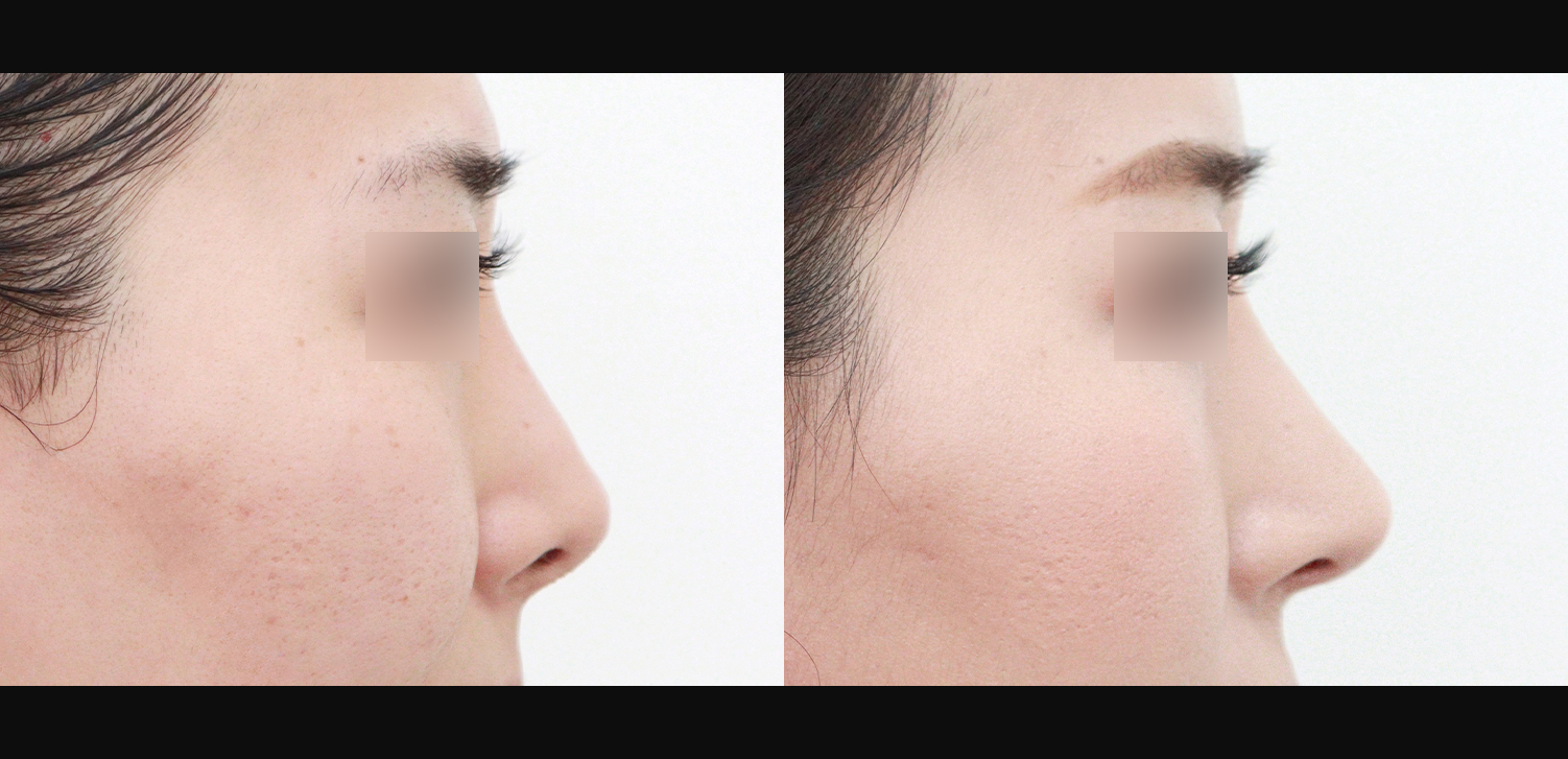 3D 코성형 재수술(콧대+코끝+휜코+기능코)