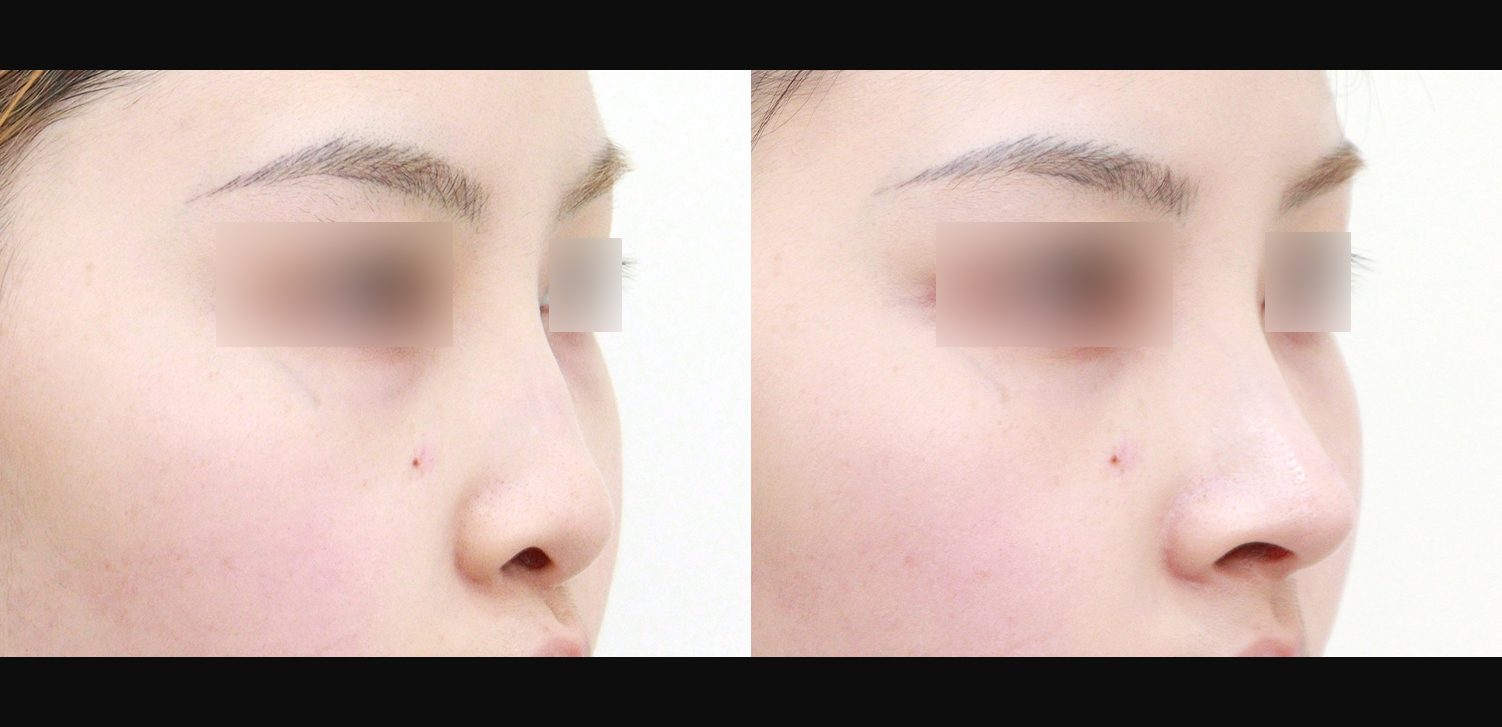 코끝+복코+인중코