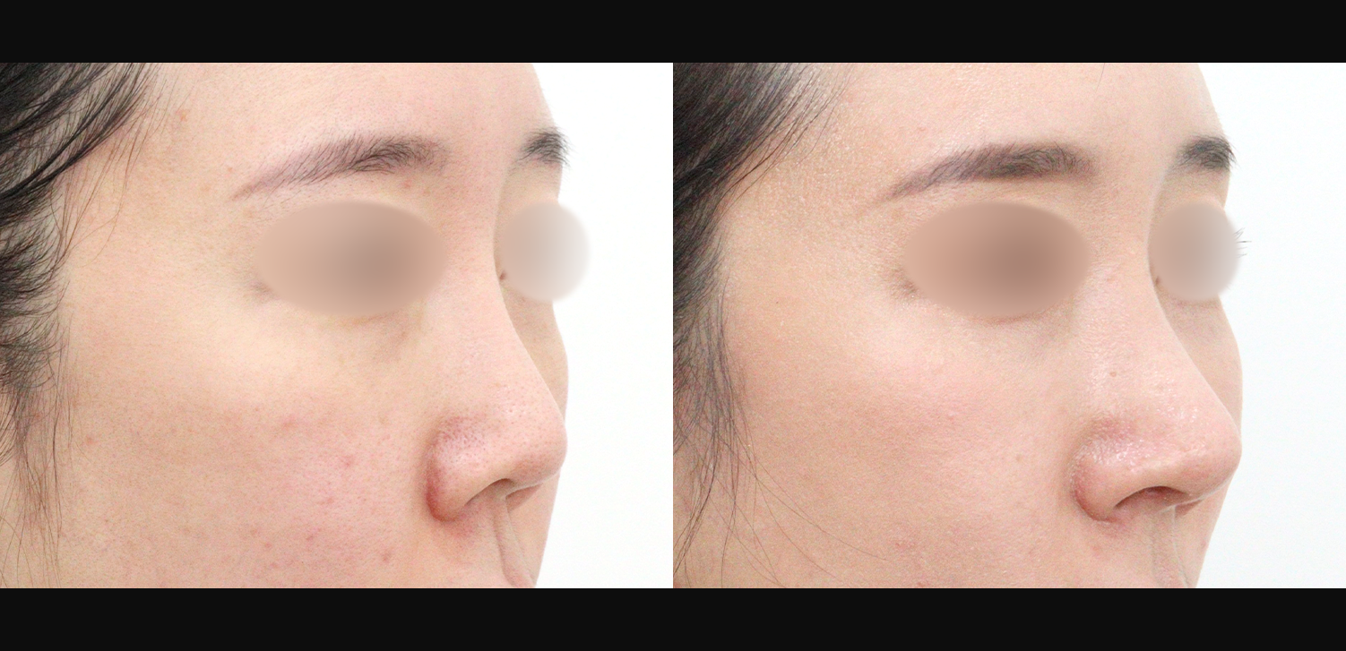 3D 코성형 재수술(콧대+코끝+기능코)