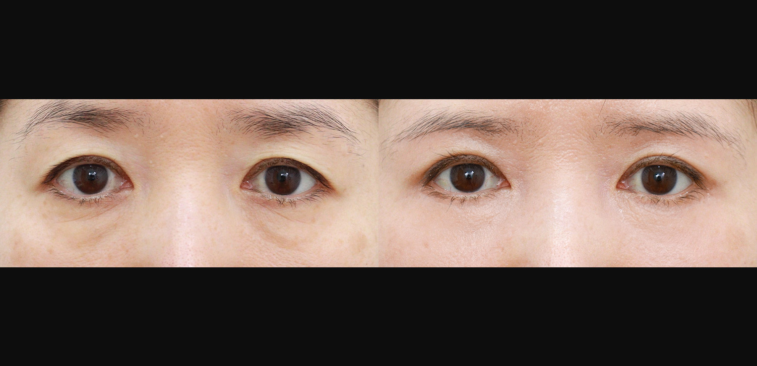 리프팅 하안검+눈썹하거상술+외안각고정술