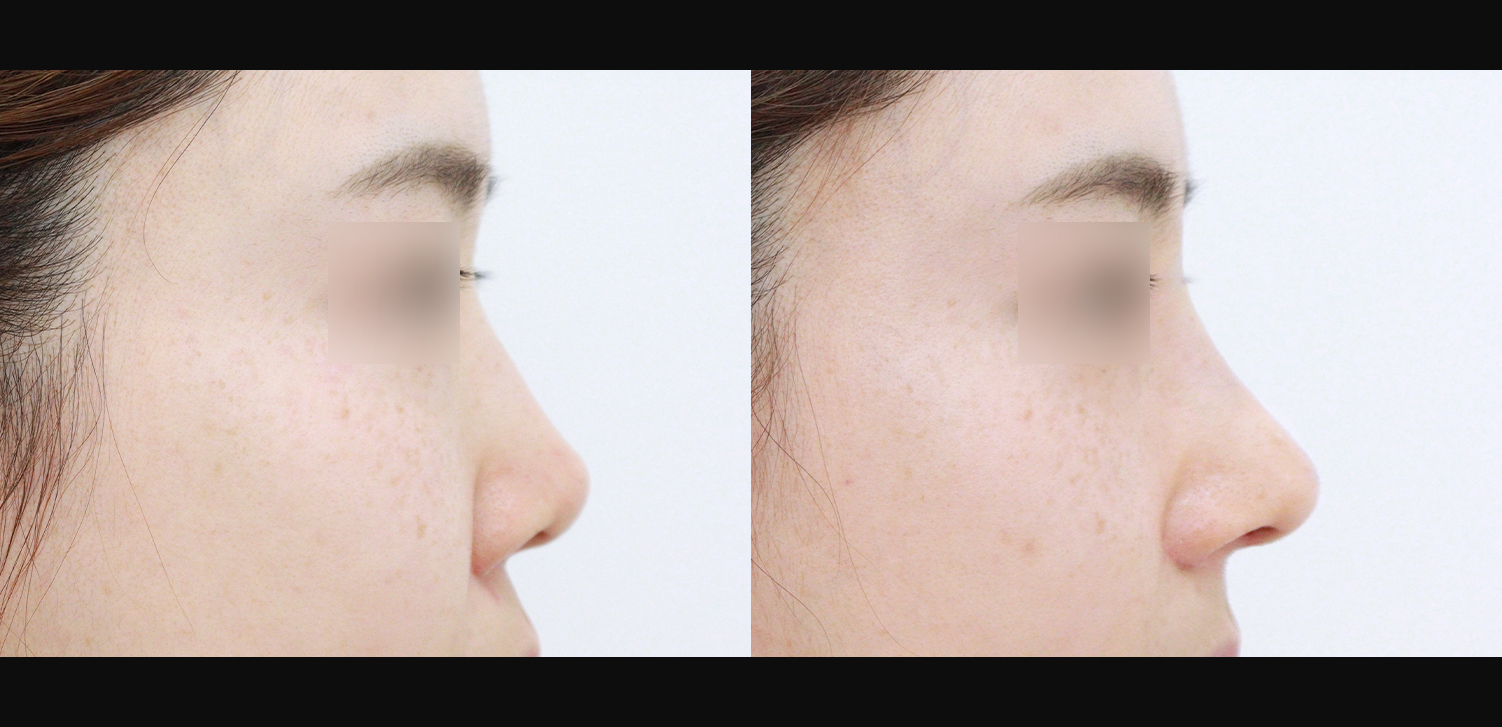 3D 코성형 재수술(콧대+코끝+콧볼축소+인중코)