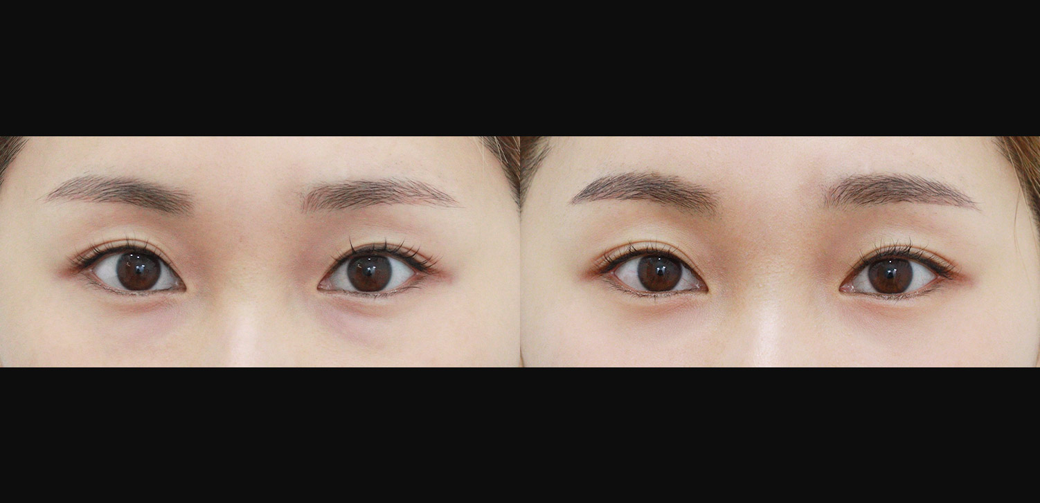 눈밑지방재배치+지방이식(앞광대)