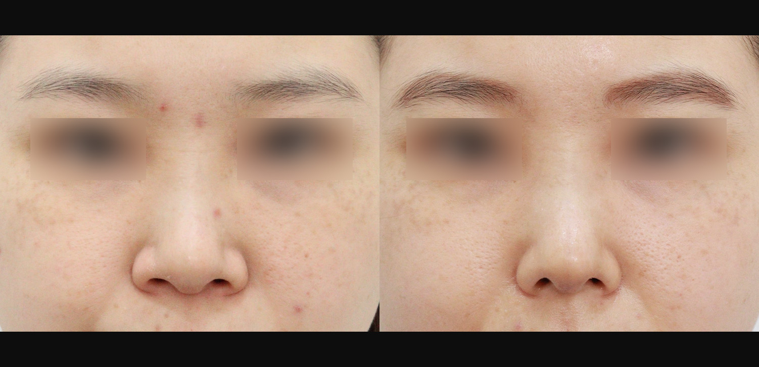 코재수술(콧대+코끝+휜코+인중코)