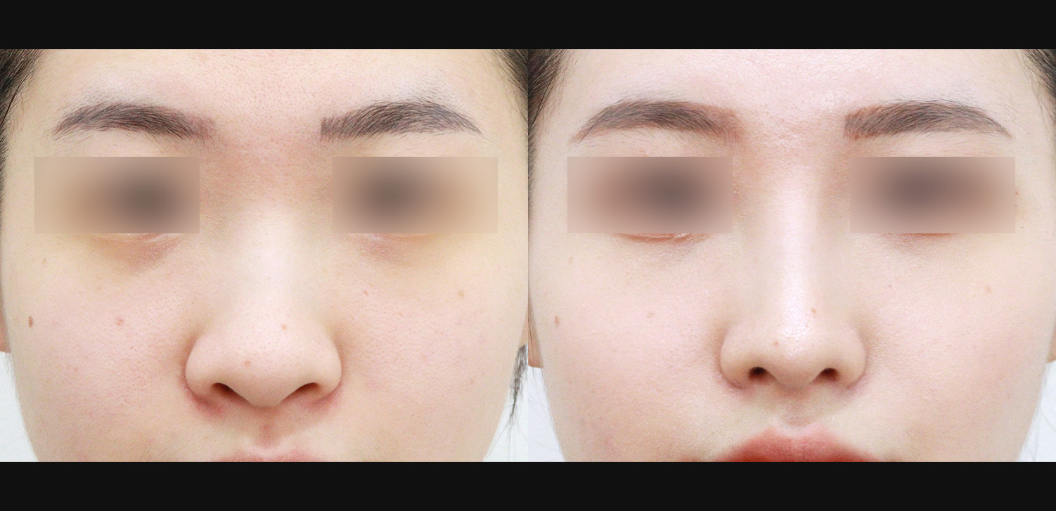 3D코성형 재수술(휜코+복코+기능코)