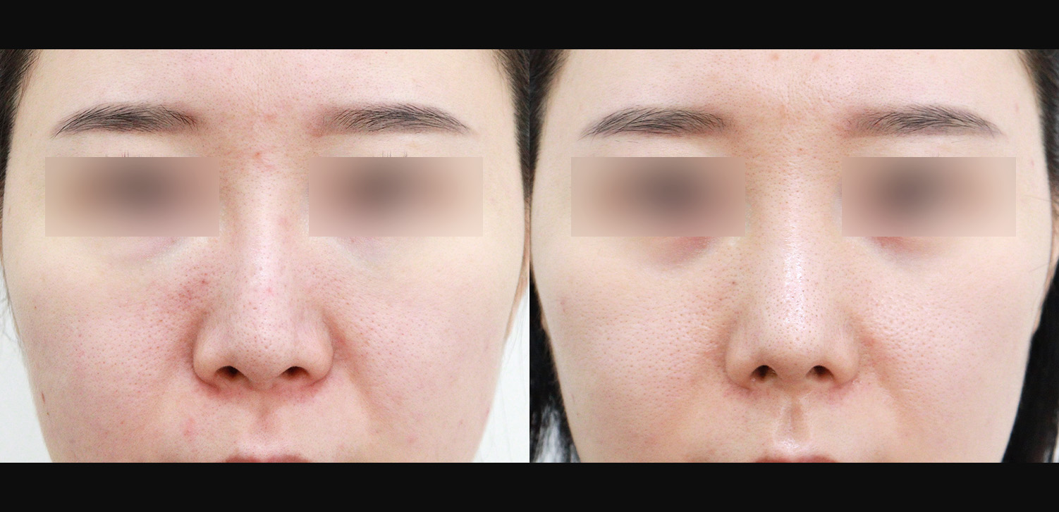 3D코성형 재수술(인중코+기능코)