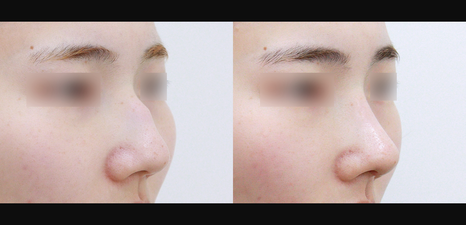 코끝+매부리+기능코