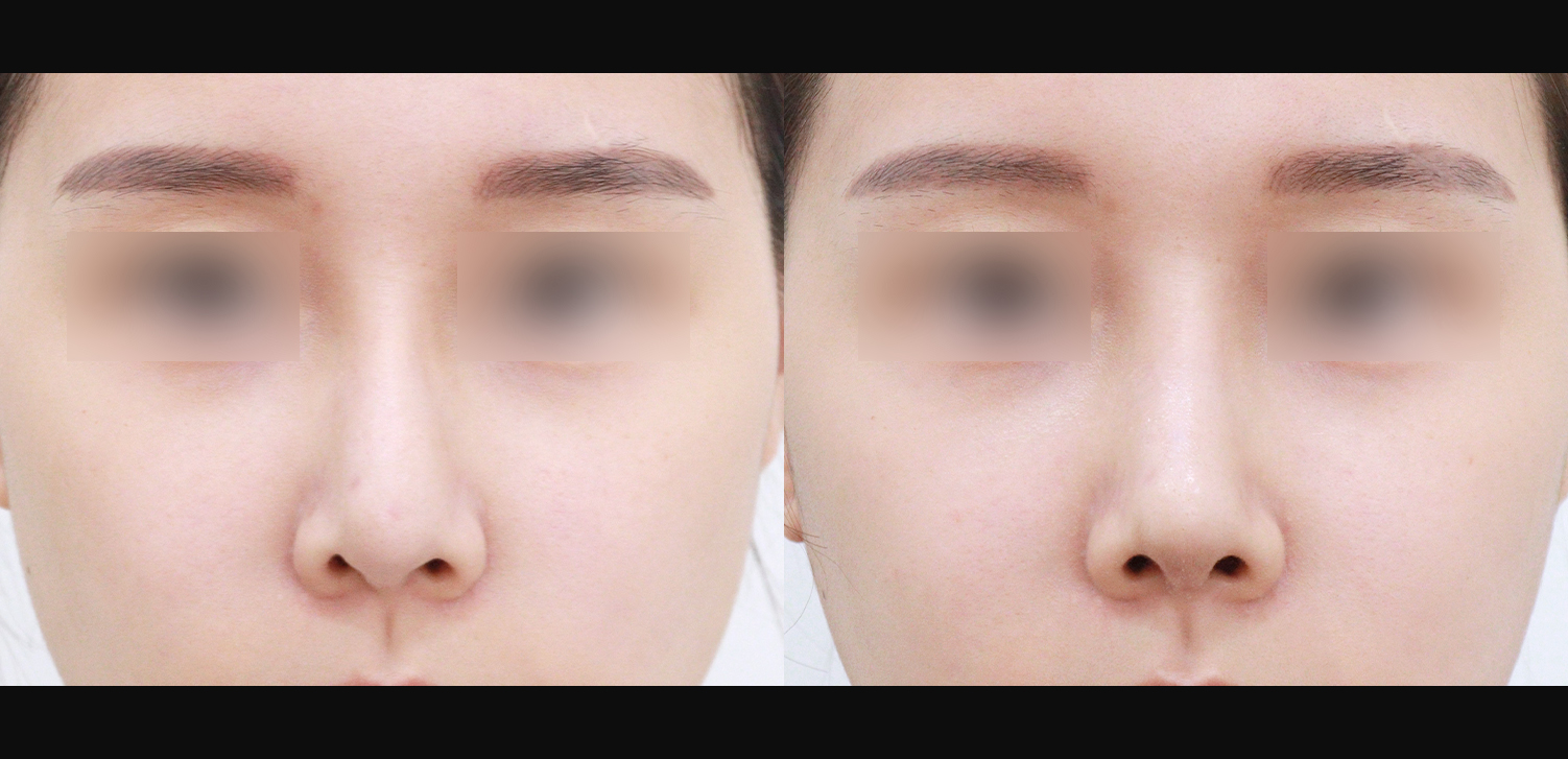 3D 코성형 재수술(콧대+코끝+휜코+인중코+기능코)