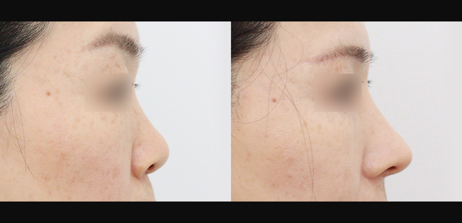 콧대+코끝+인중코+콧볼축소