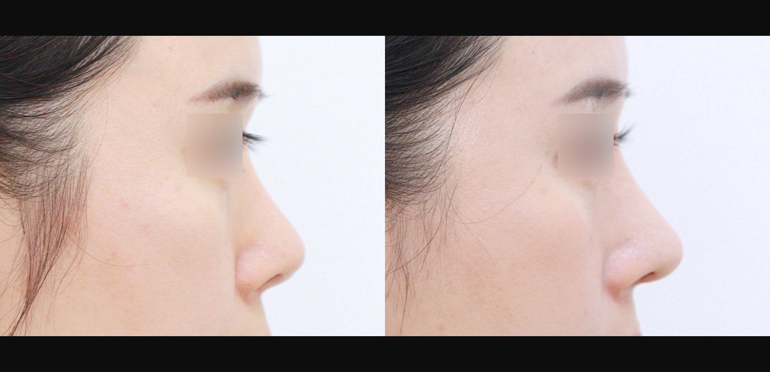 3D 코성형 재수술(콧대+코끝+인중코+기능코)