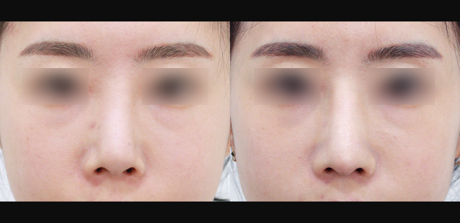 3D 코성형 재수술(콧대+코끝+들창코+인중코)