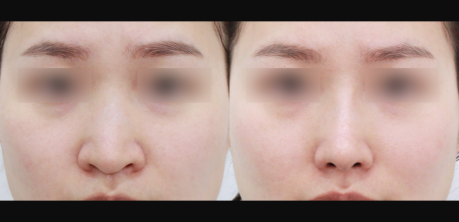 3D 코성형(콧대+코끝+화살코+콧볼축소+인중코+기능코)