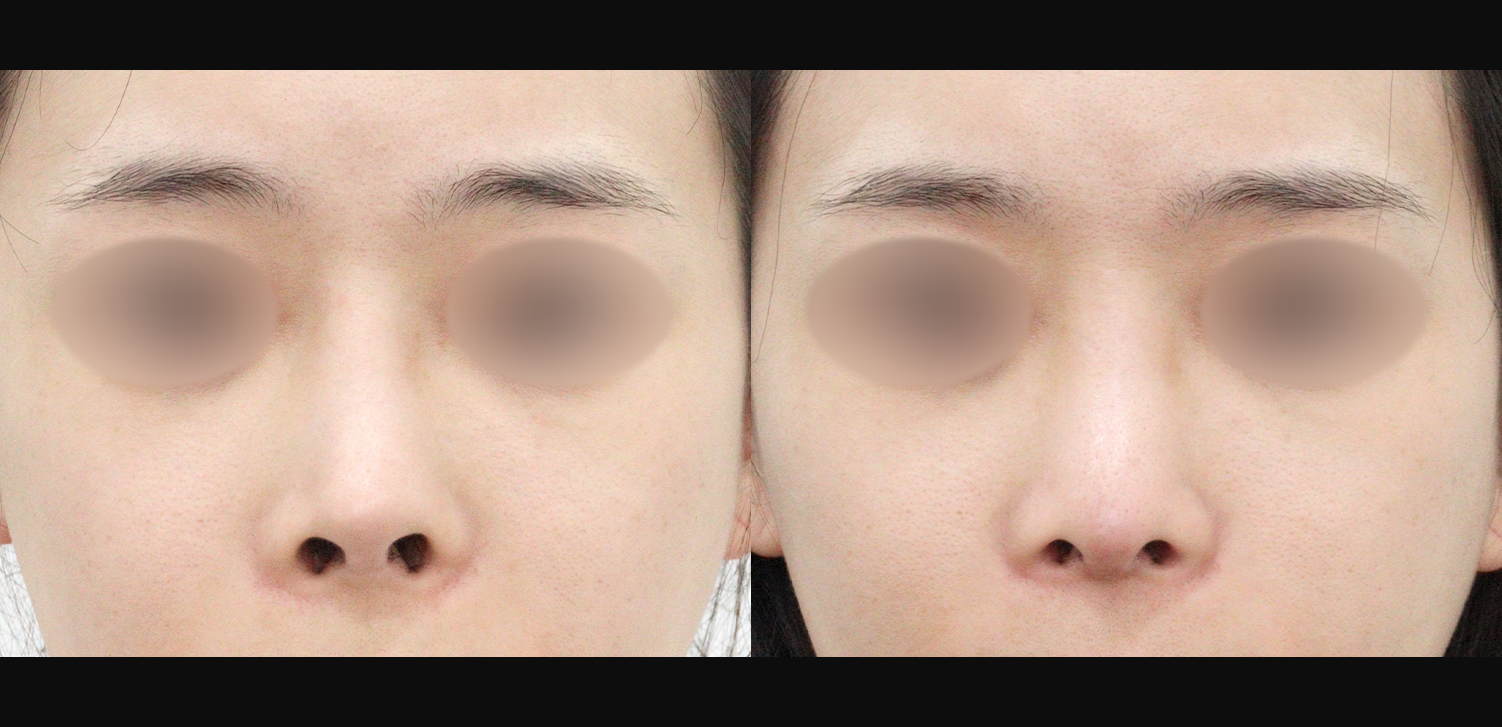 3D 코성형 재수술(콧대+코끝+기능코)
