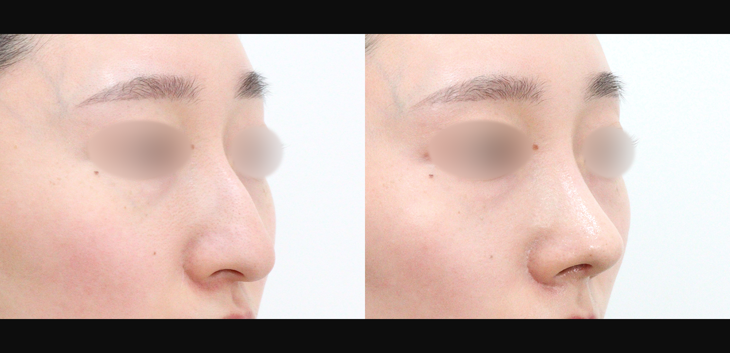 코끝+콧볼축소+기능코