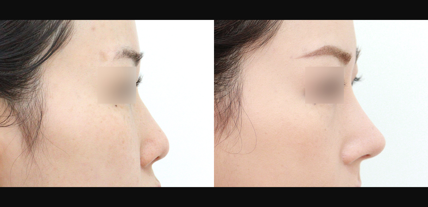 콧대+코끝+인중코+기능코