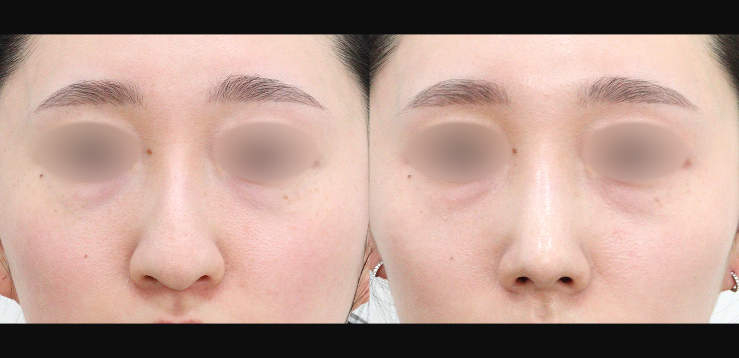 코끝+콧볼축소+기능코