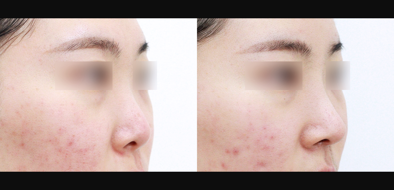 콧대+코끝+인중코