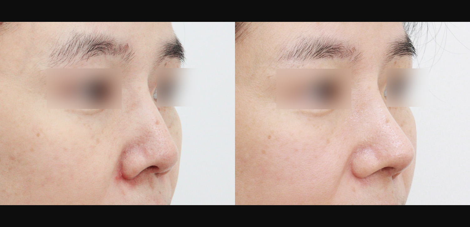 3D 코성형 재수술(콧대+코끝+인중코+기능코)