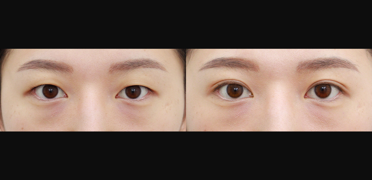 자연유착+눈매교정