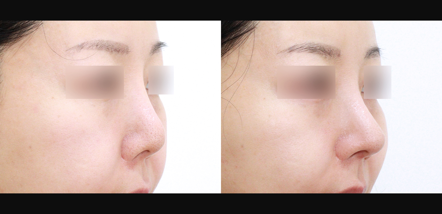 3D 코성형 재수술 (인중코+들창코+찝힌코+비중격재건+기능코)