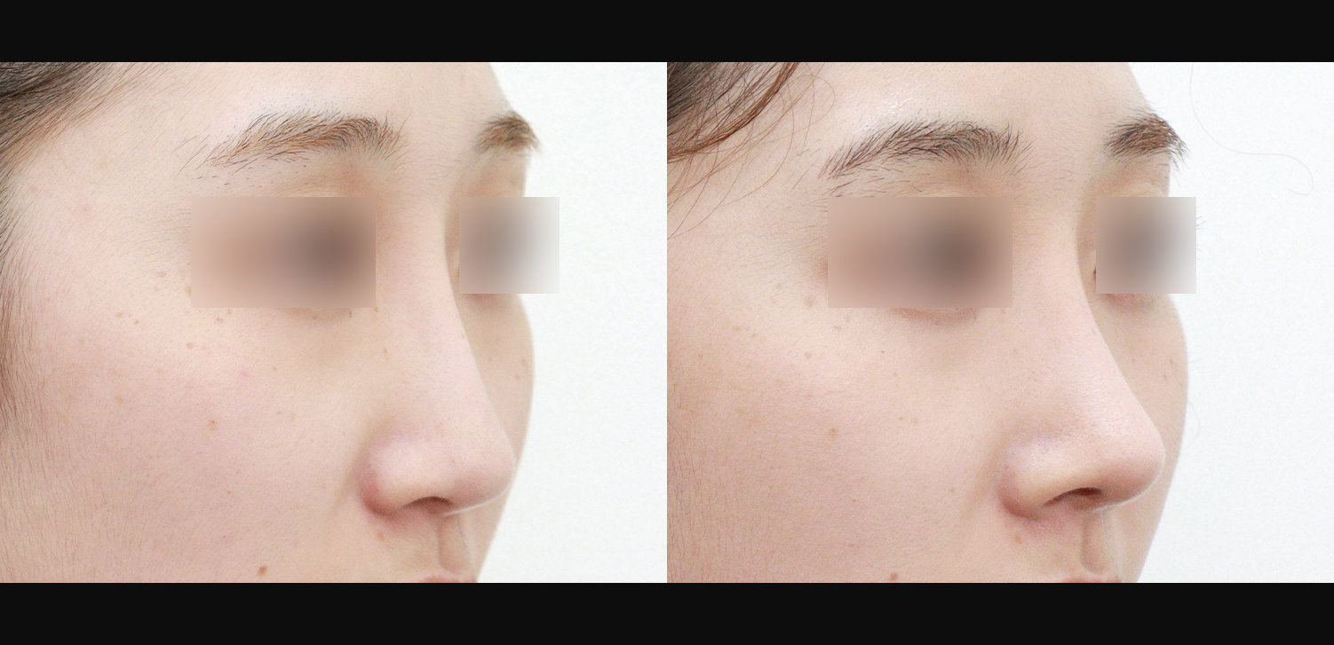 3D 코성형 재수술(콧대+코끝+화살코+인중코)