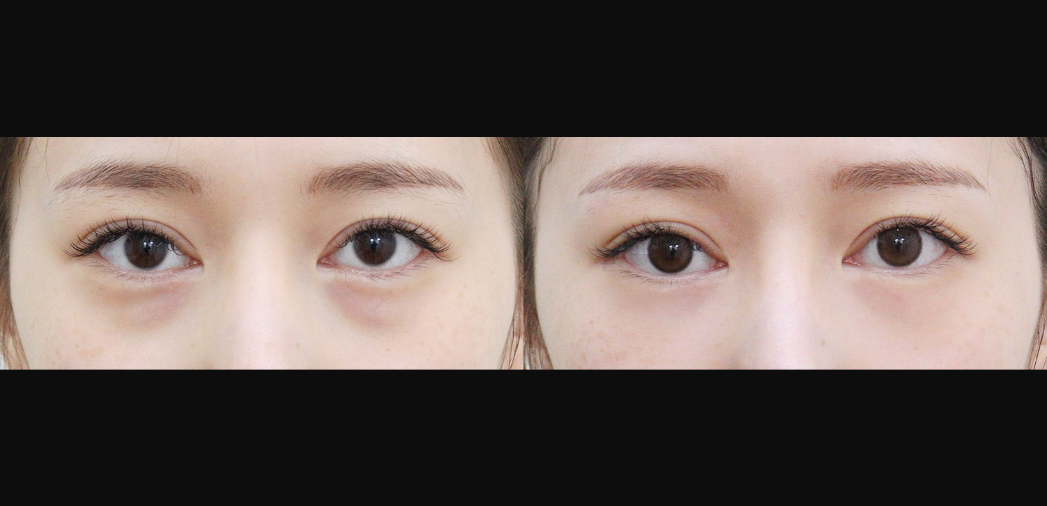 눈밑지방재배치+지방이식(앞광대)