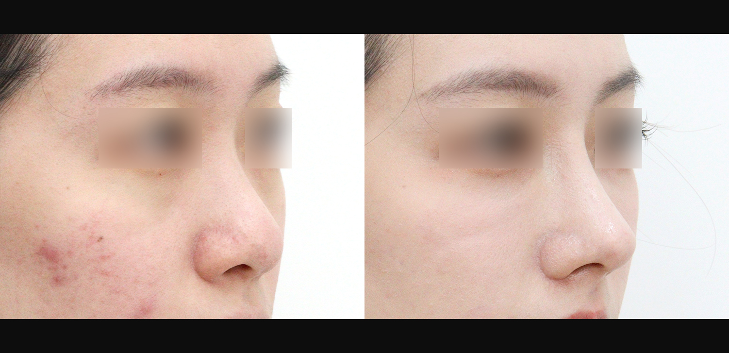 콧대+코끝+인중코