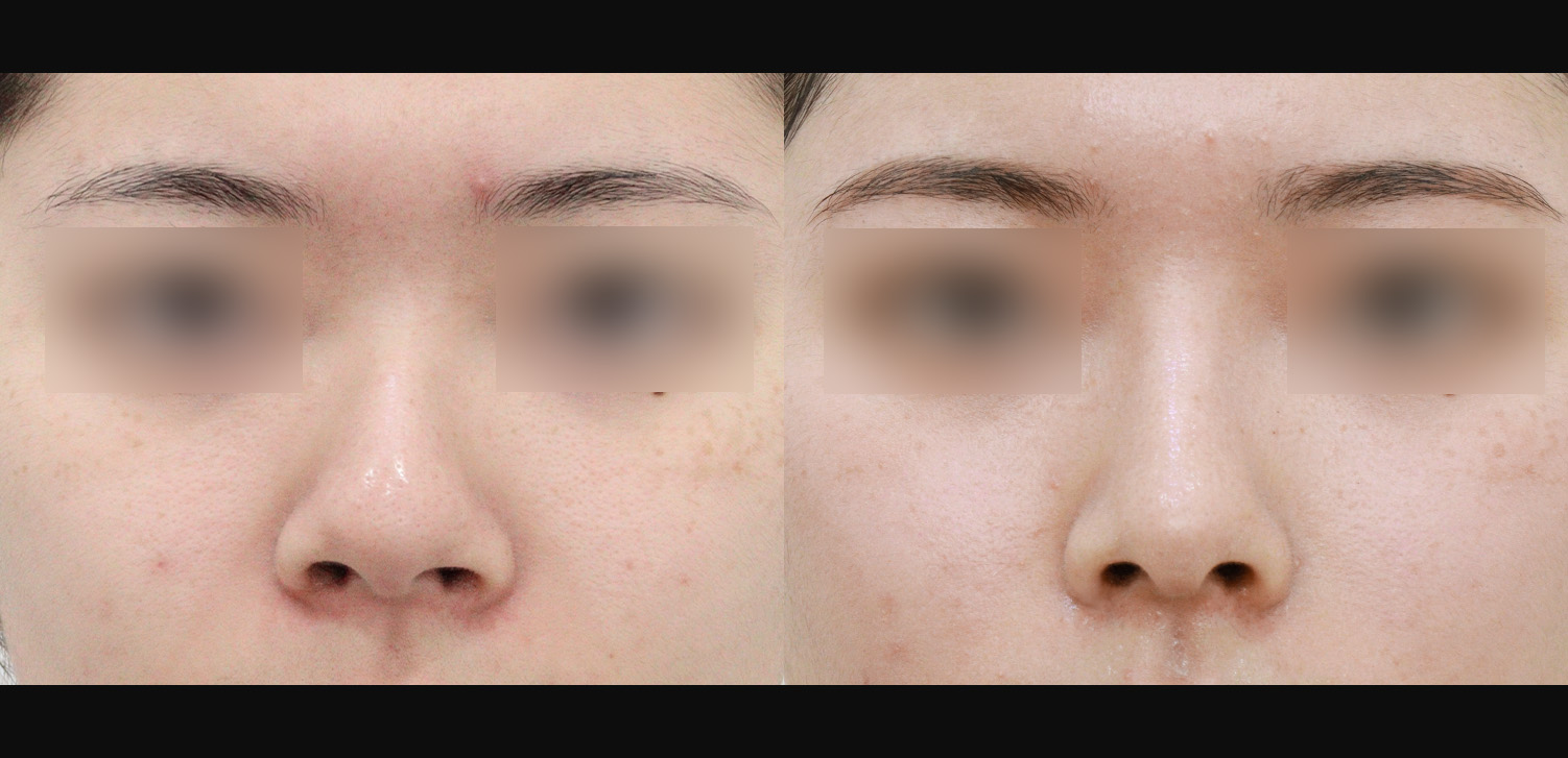 콧대+코끝+인중코+콧볼축소+기능코