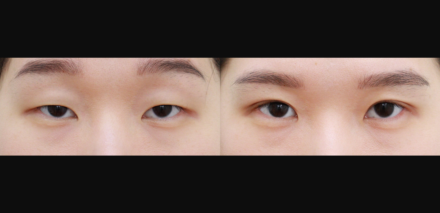 절개 쌍꺼풀+눈매교정+트임