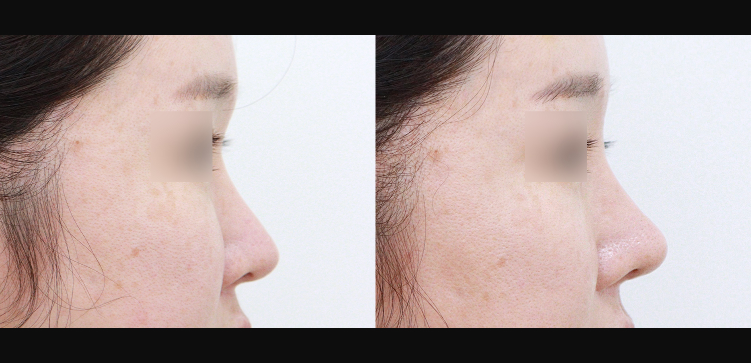 3D 코성형 재수술(콧대+코끝+복코+인중코)