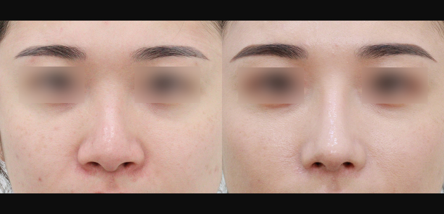 콧대+코끝+인중코+콧볼축소