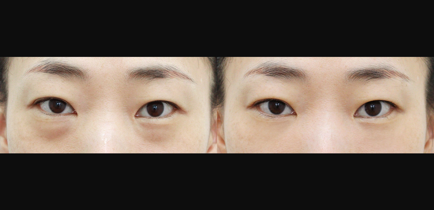 눈밑지방재배치+지방이식(앞광대)