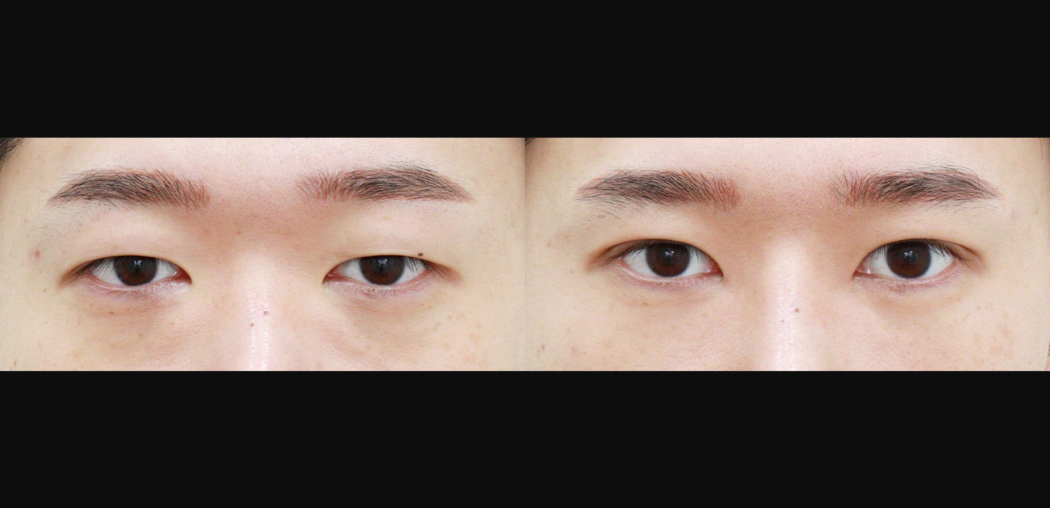 절개 쌍꺼풀+눈매교정+눈밑지방재배치+지방이식(앞광대)