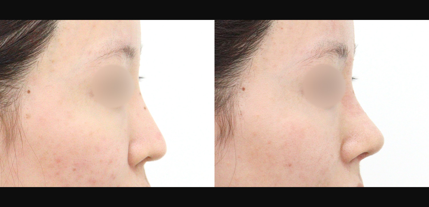 3D 코성형 재수술(콧대+코끝+기능코)