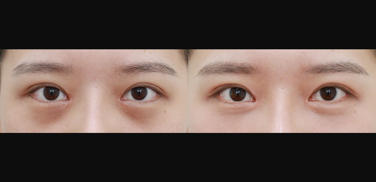 눈밑지방재배치