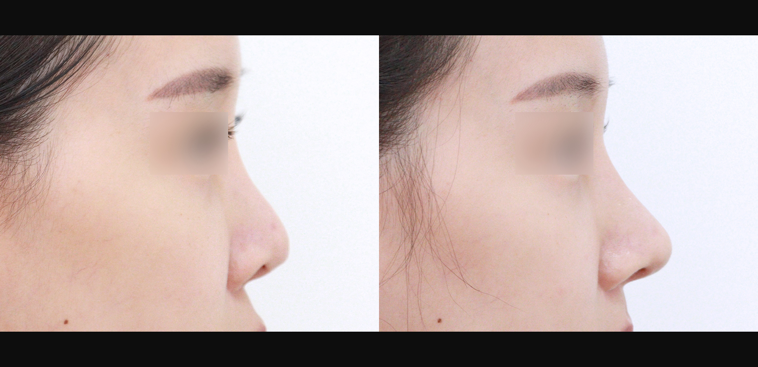 3D 코성형 재수술(콧대+코끝+휜코+인중코+기능코)